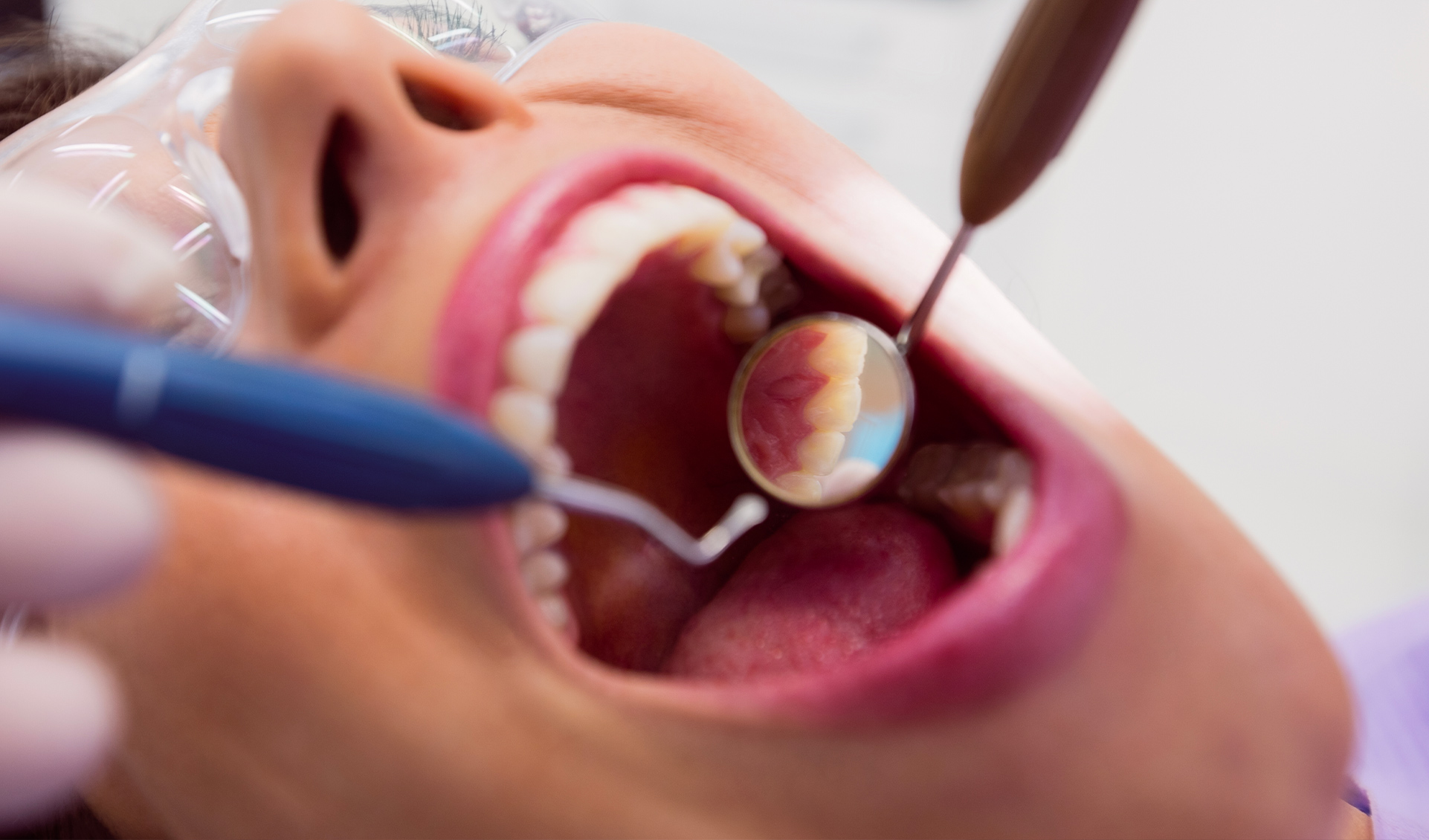 Intarsi dentali: differenze, durata e vantaggi rispetto alle otturazioni