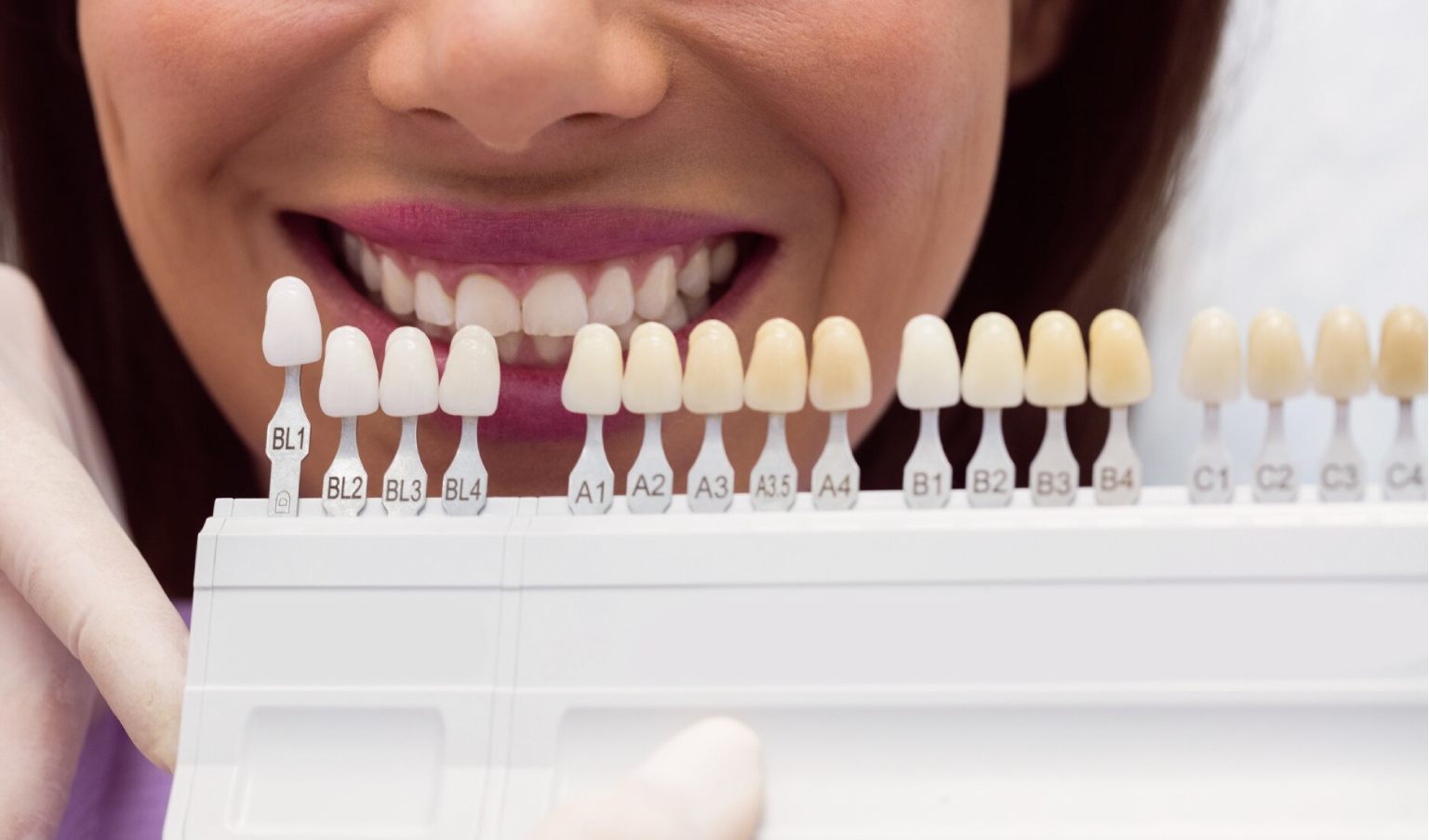 Tutto quello che c’è da sapere sulle faccette dentali